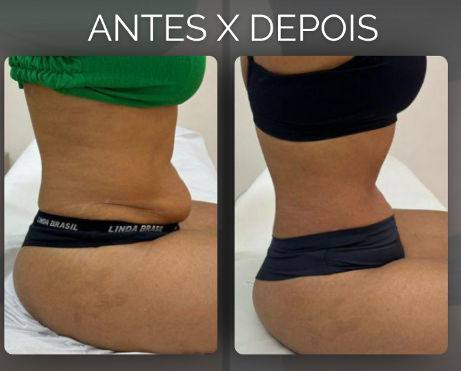 Resultado de emagrecimento